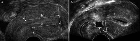 cesarean section ultrasound uk